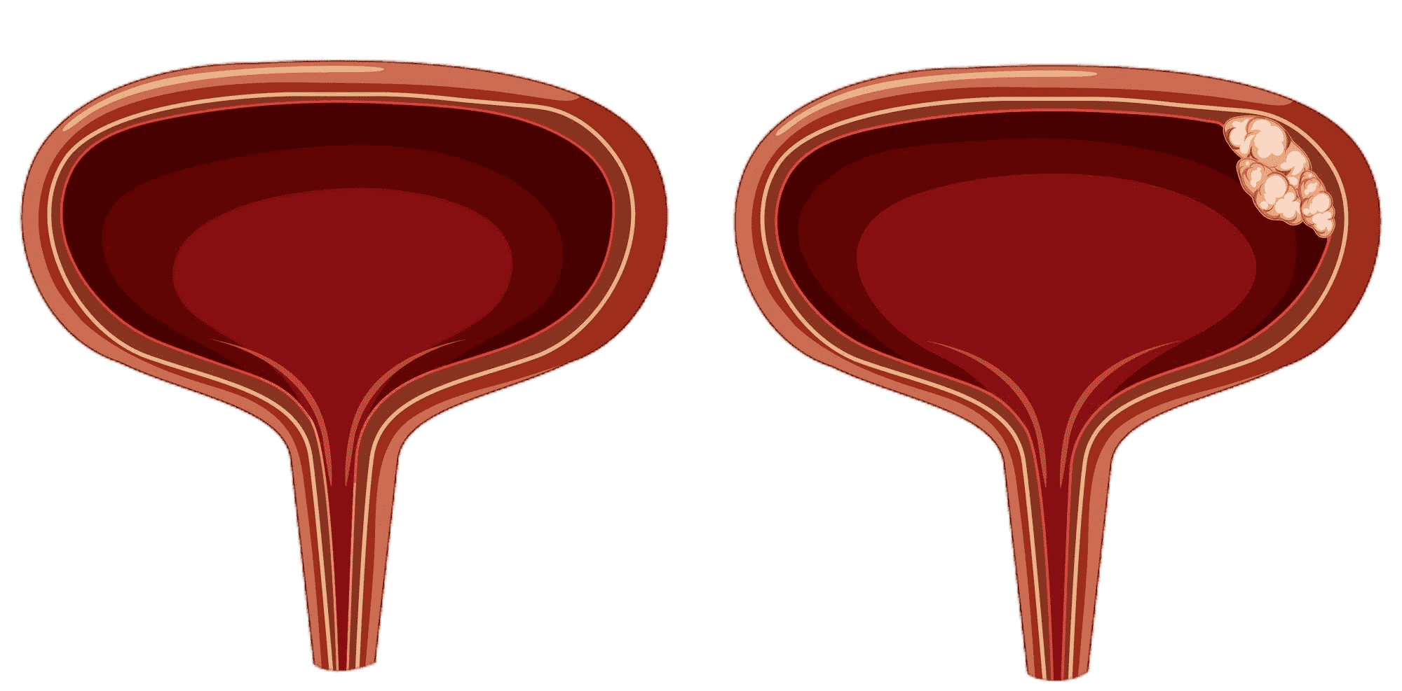 Bladder Condition
