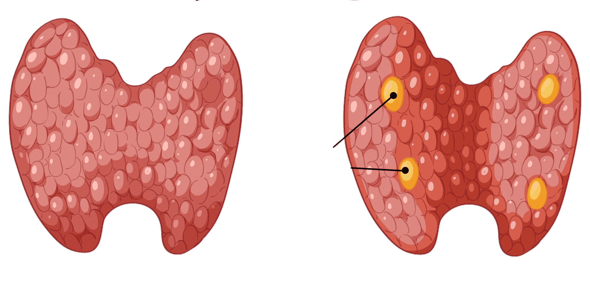Thyroid